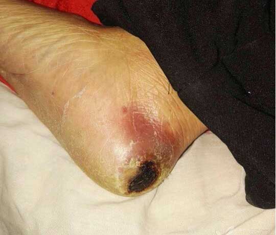 糖尿病烂脚合并尿毒症病人的治疗经历，最后还是中医保守治好了 