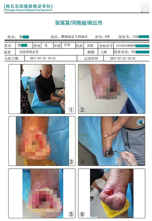检查糖尿病足要检查血管，导致烂脚的原因还有哪些？