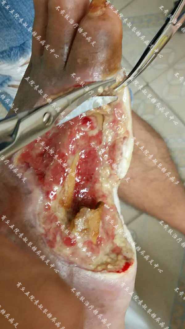 糖尿病足病人特别疼痛，用臭氧缓解治疗真的有用吗？
