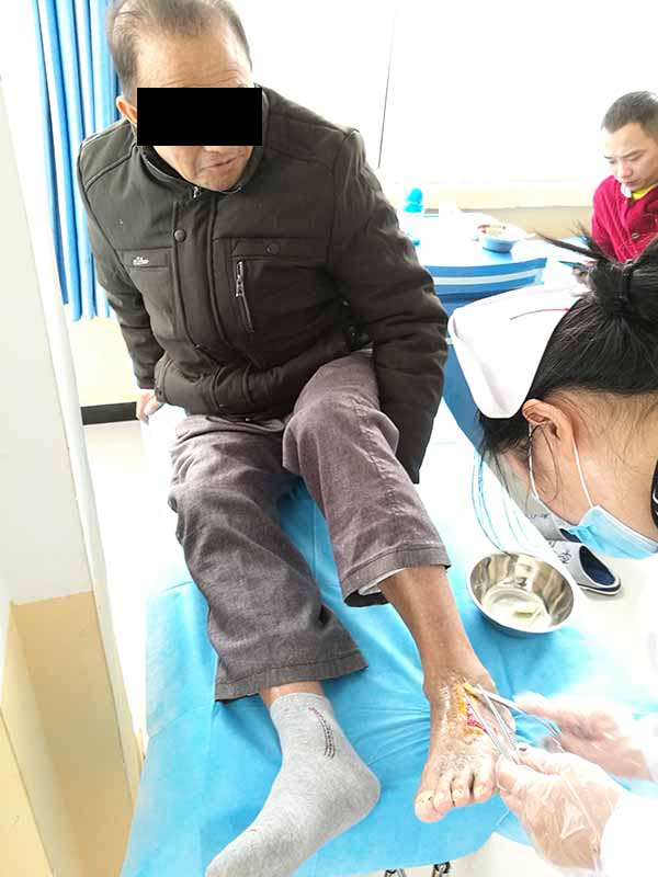 引起糖尿病烂脚的原因不只有血糖高，还有心、肾、脑、及个人生活习惯