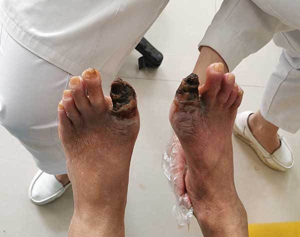 袁敏琴：糖尿病干性坏疽截肢是最好的方法吗？